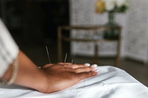 acupuncture hand treatment needles