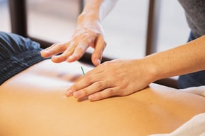 man receiving acupuncture to solve migraines